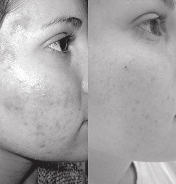 Affordable Skin Care Tips to Battle Breakouts and Acne