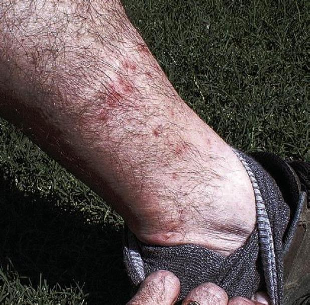 Chigger Season Tips to Beat the Itch